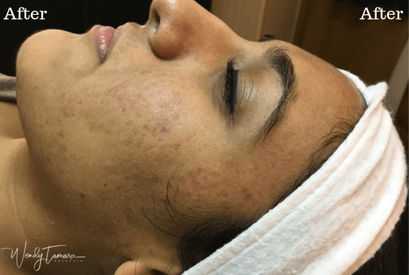 ethnic skin acne clearing