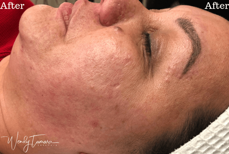 cystic acne clearing olympia