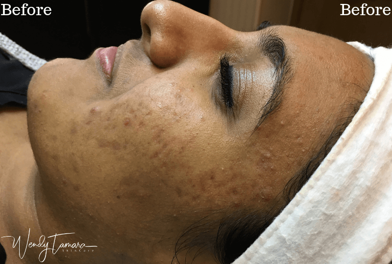 acne ethnic skin