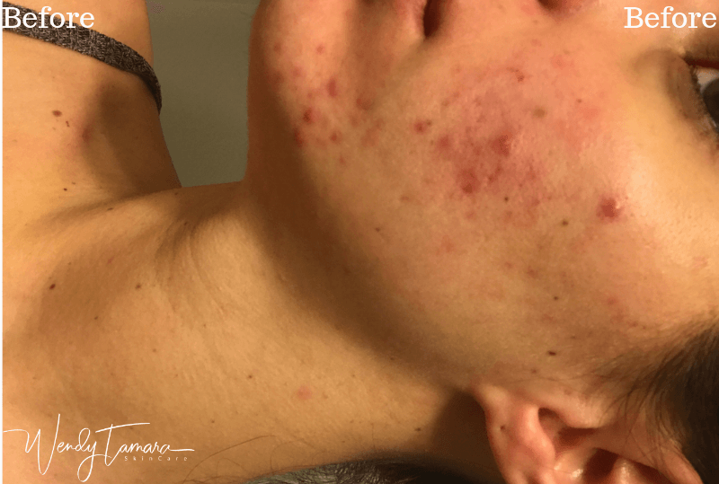 painful acne olympia