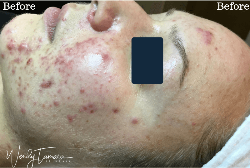 cystic acne clearing no medication