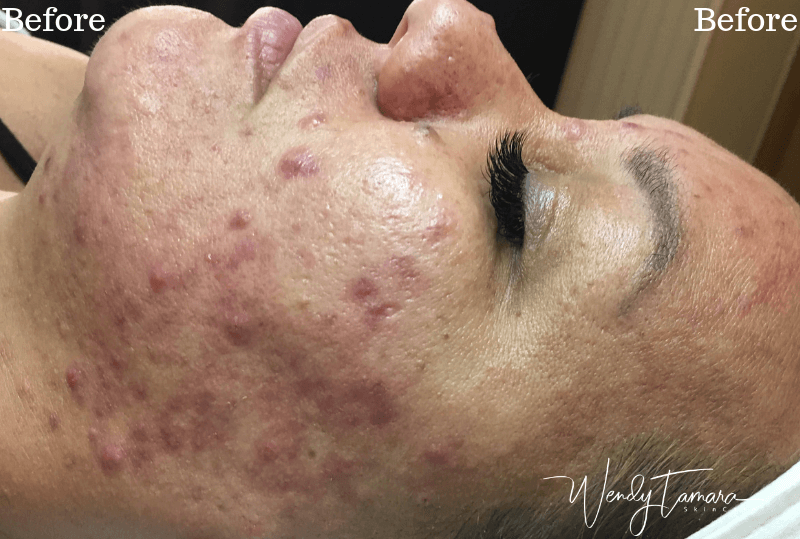 cystic acne clearing