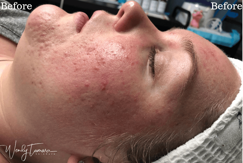 hormonal acne clearing