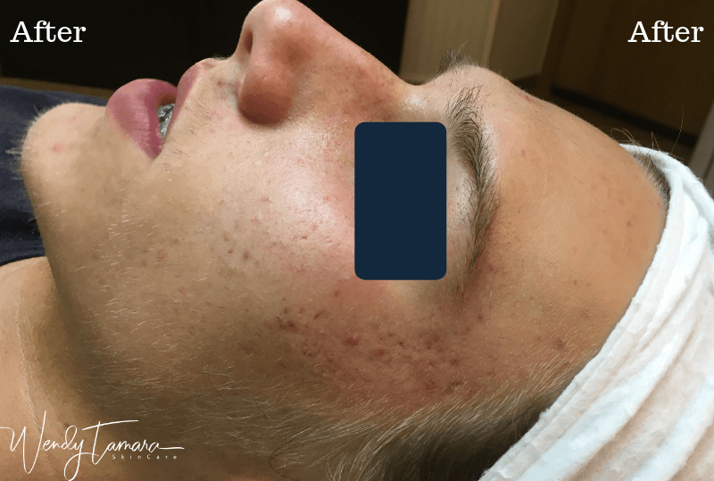 male hormonal acne clearing
