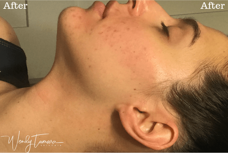 after acne treatment olympia