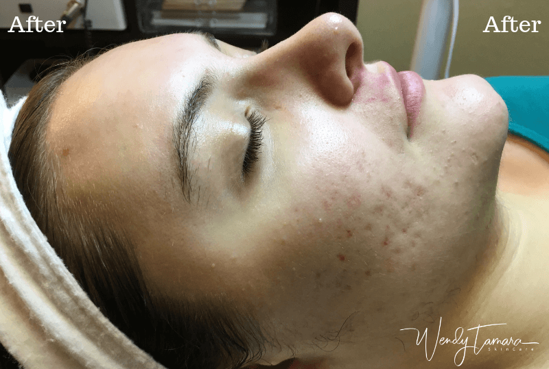 female hormonal acne clearing